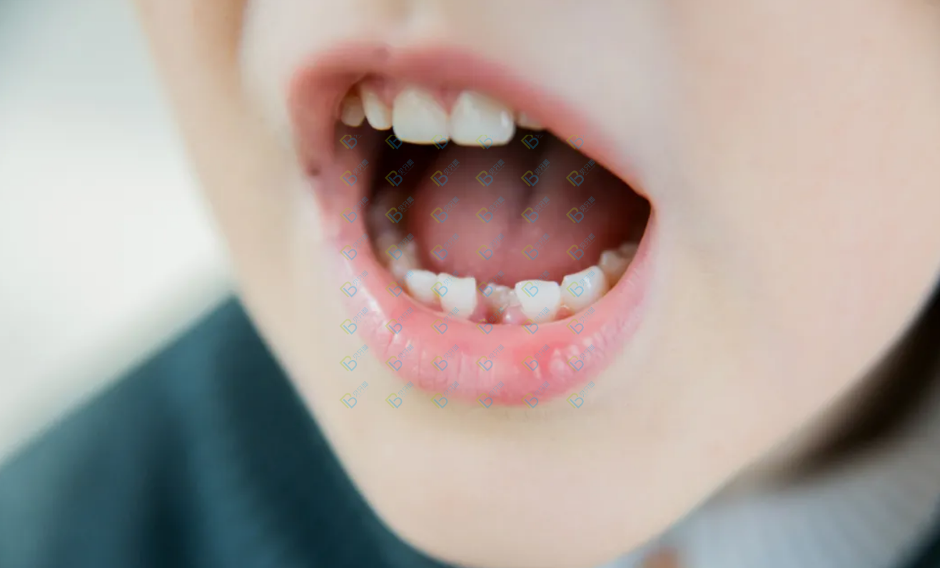 孩子好好的乳牙怎么越長越歪了呢？