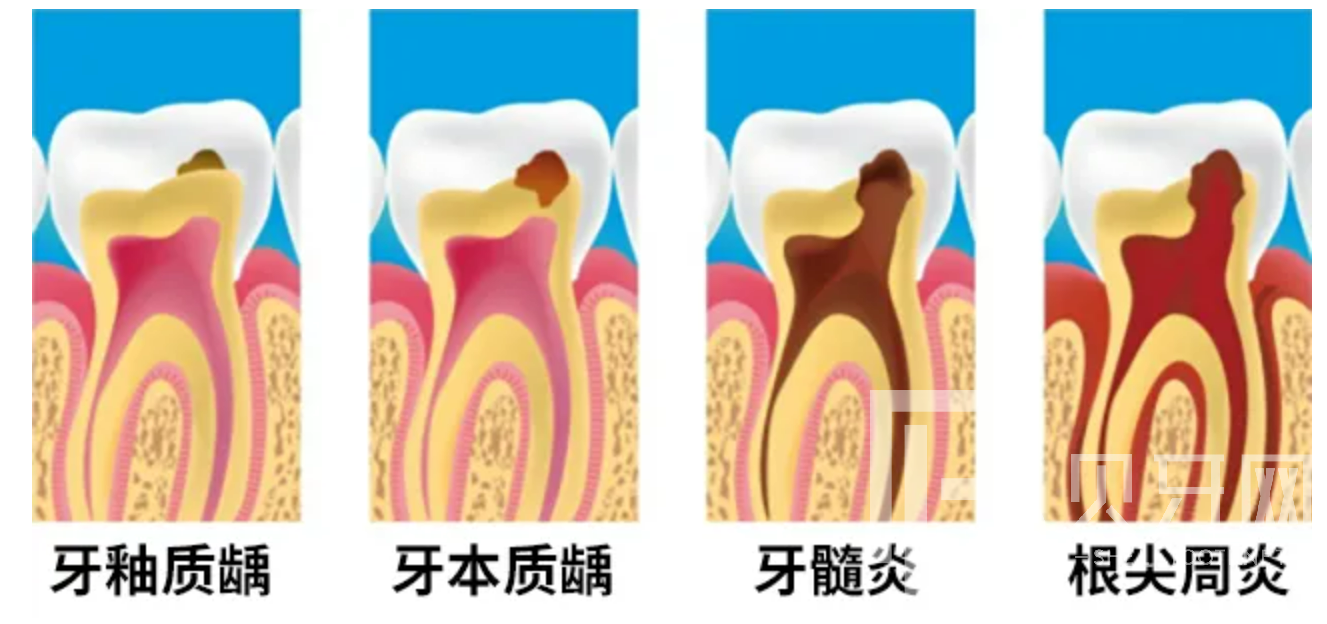 牙疼到無(wú)法入睡，我們?cè)撛趺崔k？