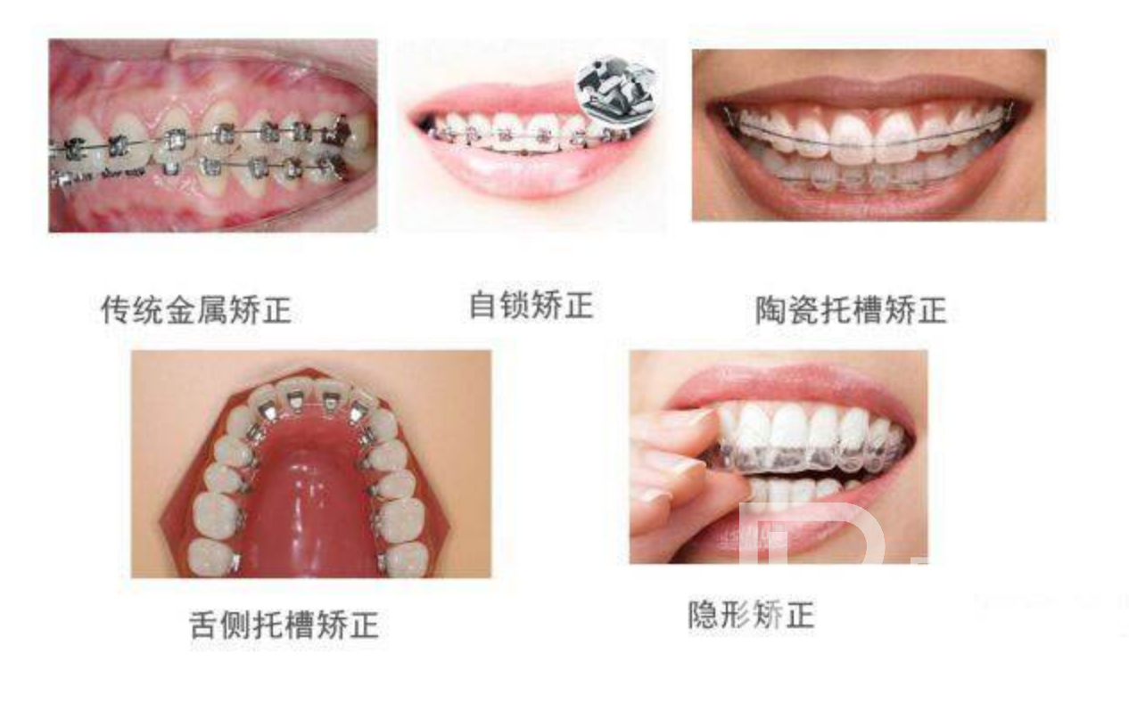 牙齒不整齊都有哪些矯正方式?分別價格多少錢？