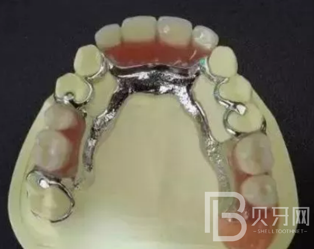 牙齒缺失一顆哪種修復(fù)方式好？