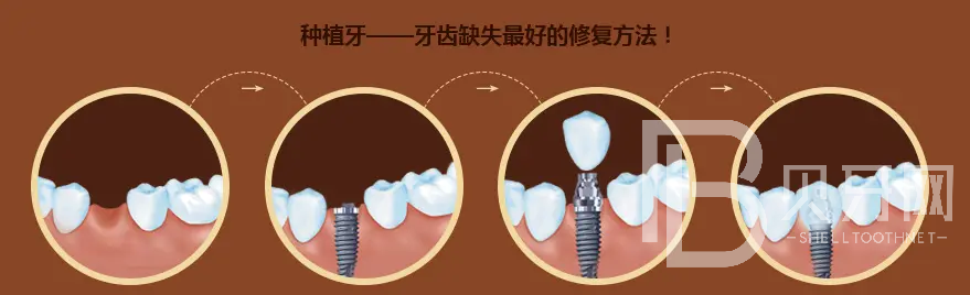北京種植牙哪里好？北京德貝口腔怎么樣？