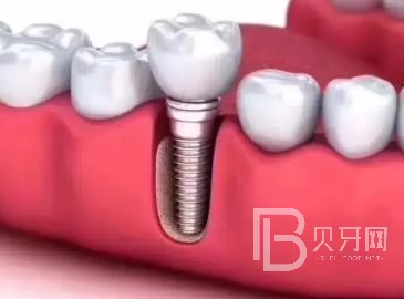 廣州研科口腔醫(yī)院怎么樣？廣州研科口腔口碑好不好？廣州研科口腔種植牙多少錢