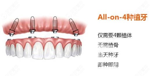 滿口種植牙需要種幾顆？北京佳美口腔正規(guī)嗎？