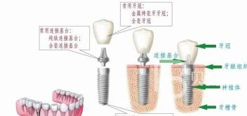 70歲的老人骨量不足還能做種植牙嗎？北京海德堡口腔怎么樣？