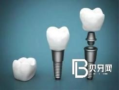 北京種植牙齒價(jià)格多少？含北京種植牙價(jià)格表！